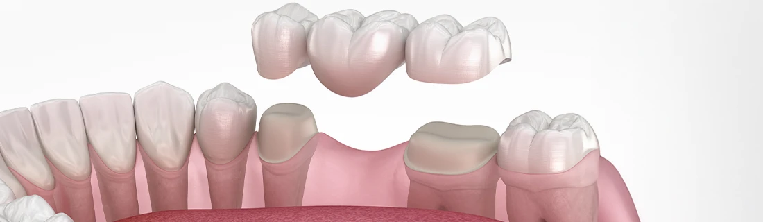 Dental Bridges in San Diego CA