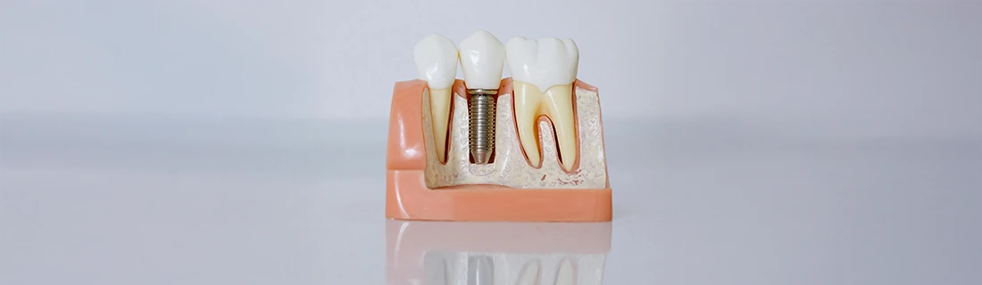 Dental Implant Benefits in San Diego CA