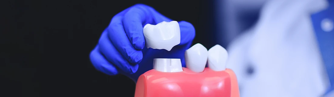 Dental Crowns FAQs in San Diego CA