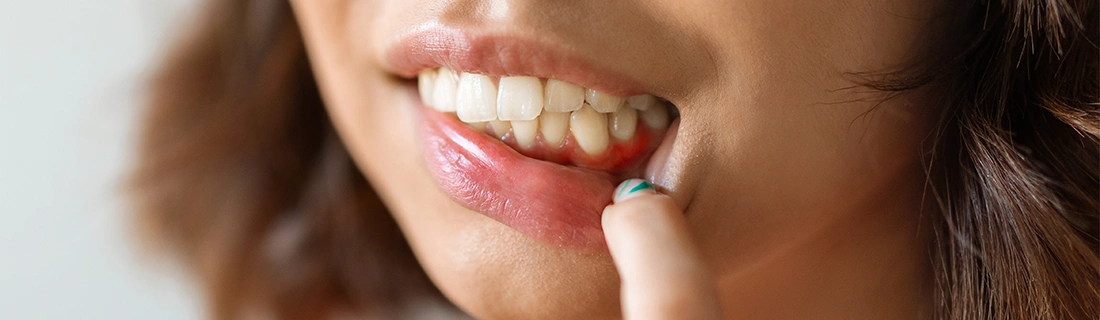 Gum Disease Treatment in San Diego CA
